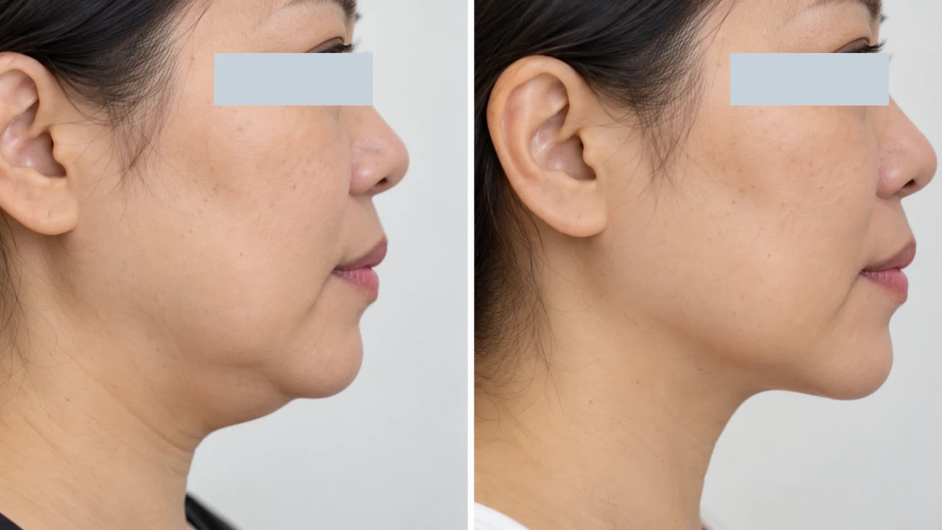 Belkyra before-and-after case 1
