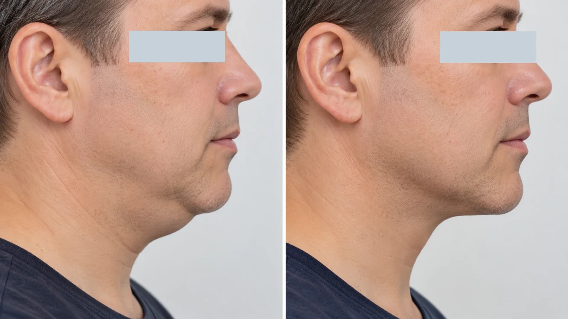 Belkyra before-and-after case 2