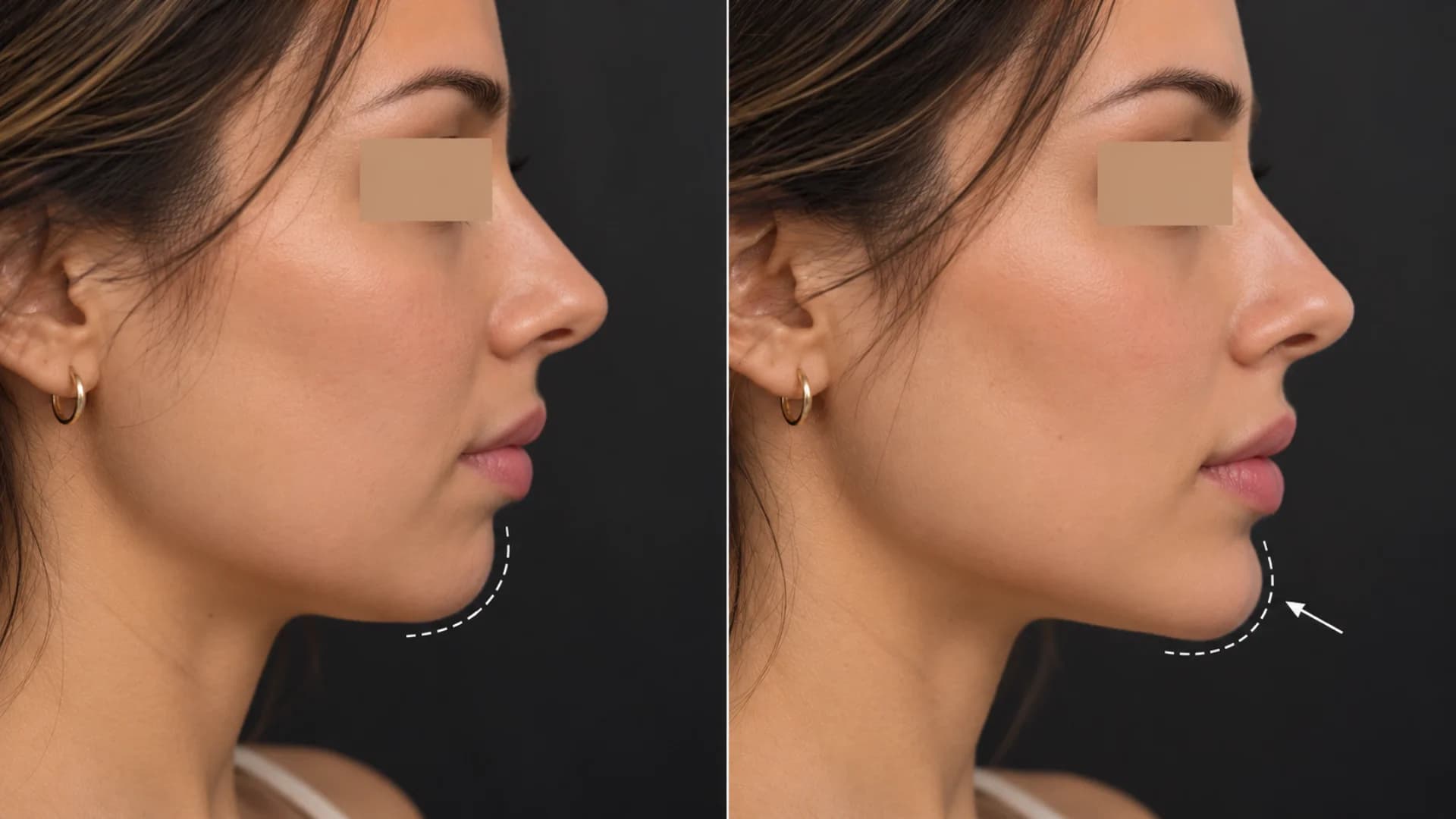 Dermal filler before and after case 1