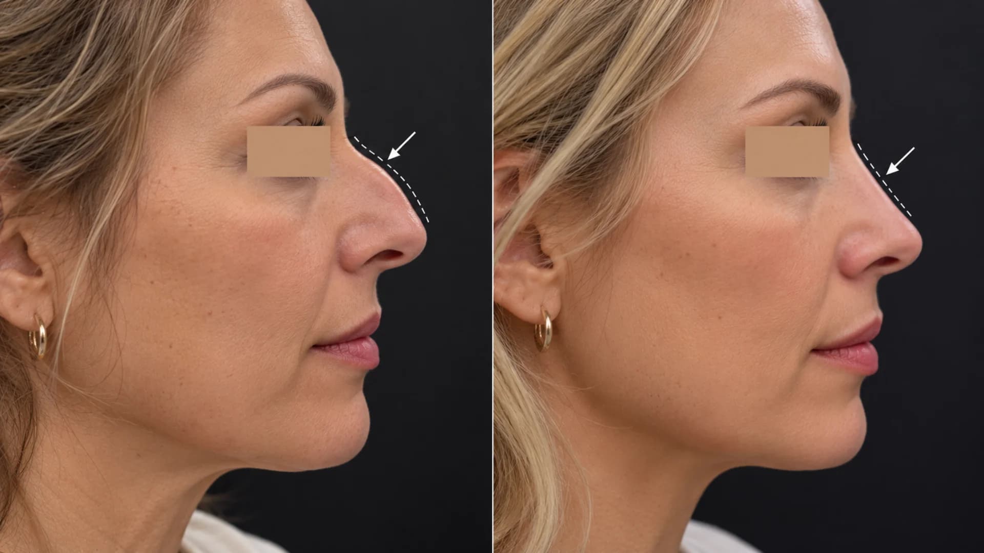 Dermal filler before and after case 3