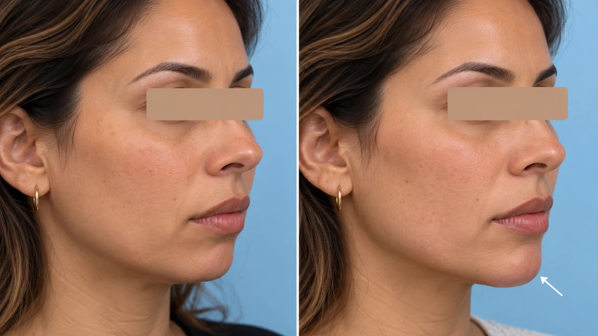 Dermal filler before and after case 4