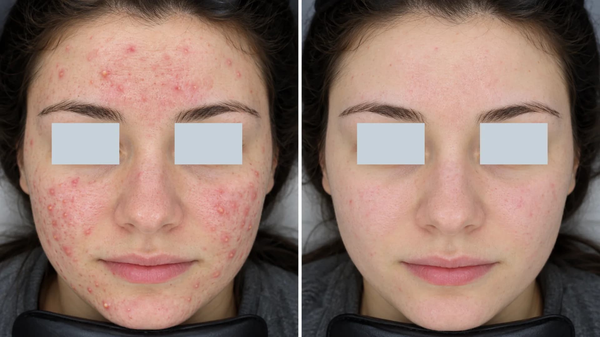 Laser acne before and after 4