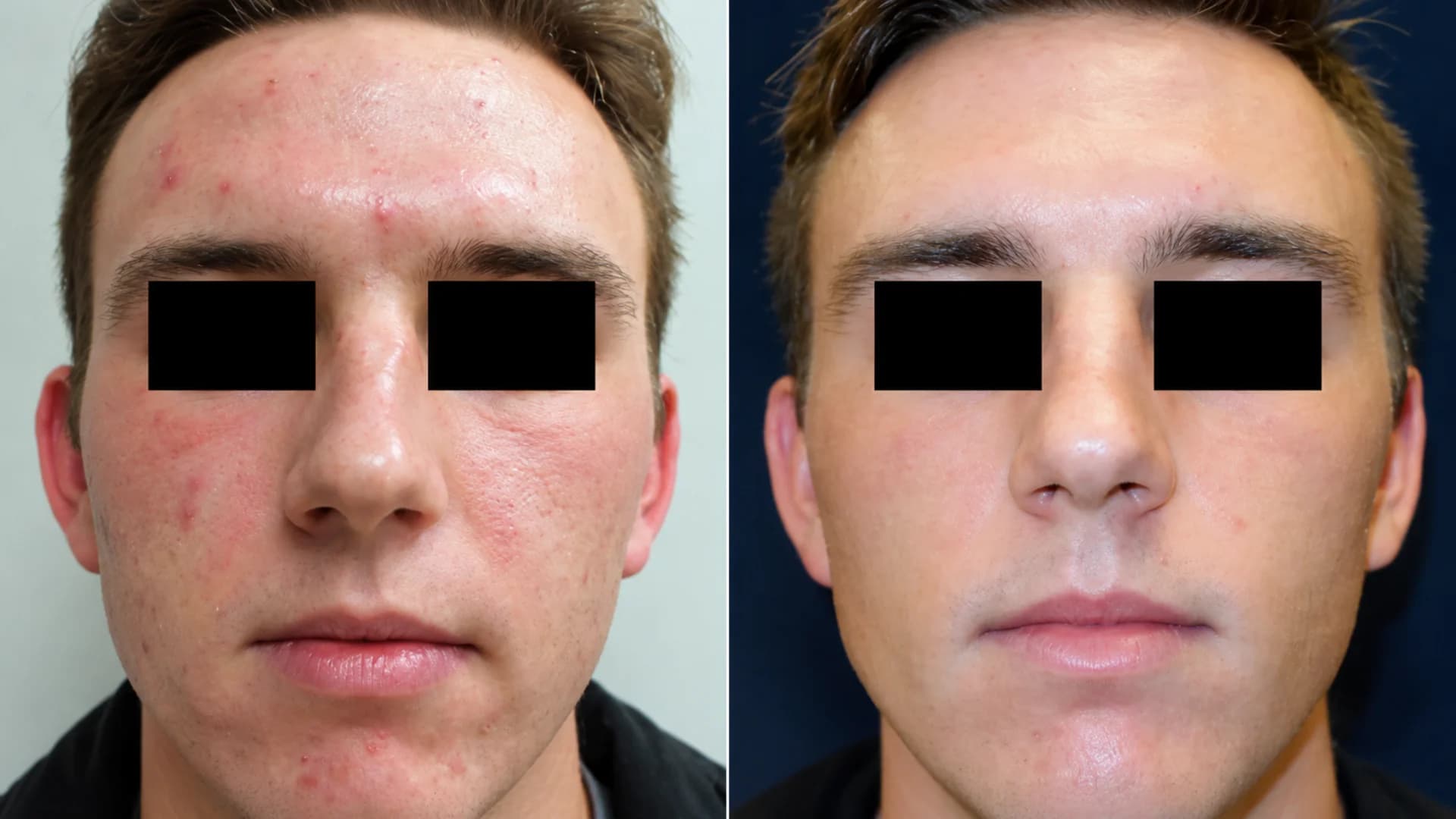 Laser acne before and after 3