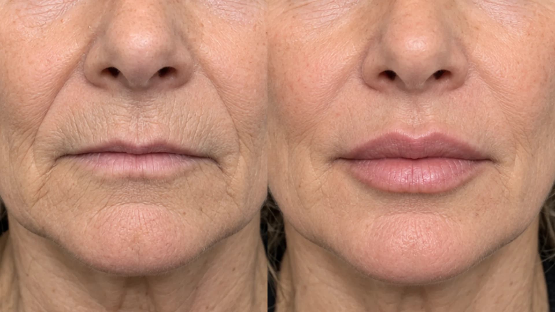 Lip Volume & Contour Balancing