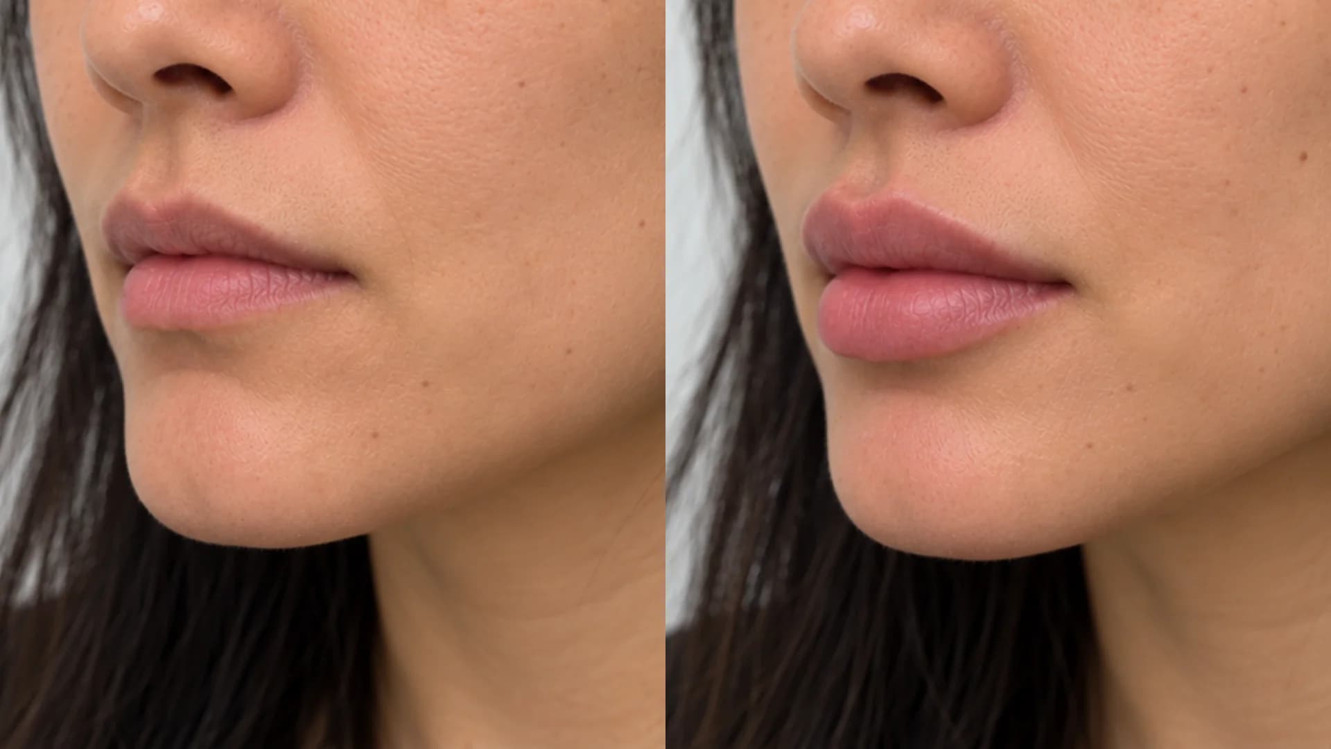 Subtle Fullness & Cupid's Bow Definition