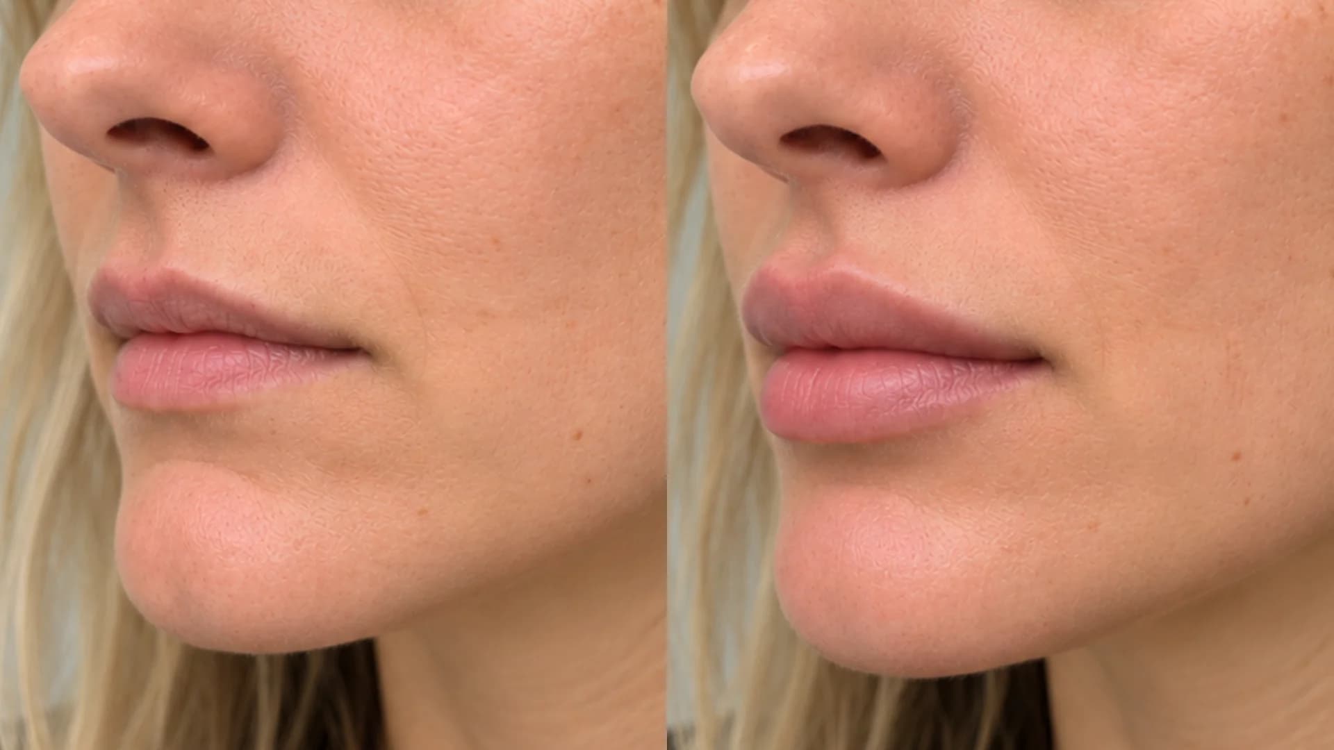 Hyaluronic Acid Hydration & Soft Fullness