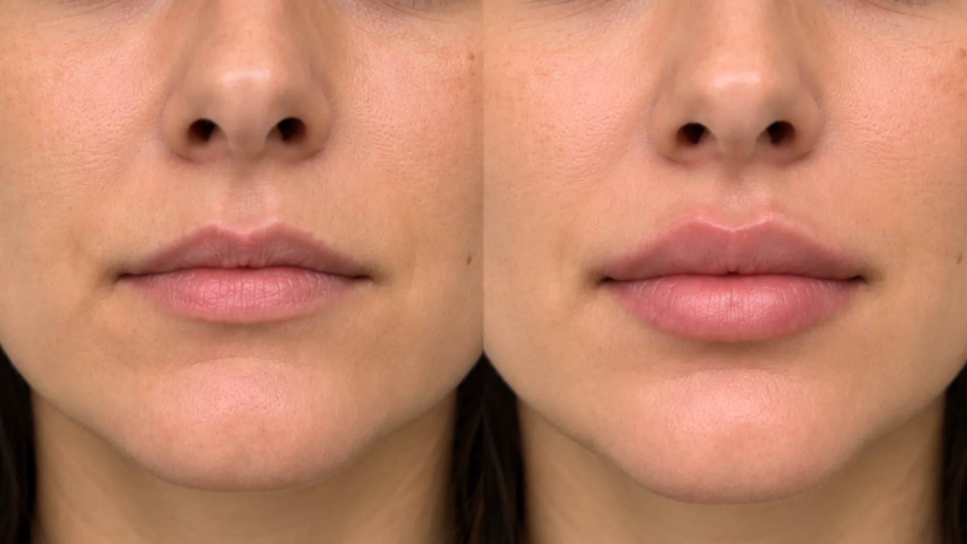 Facial Harmony & Balanced Lip Proportions