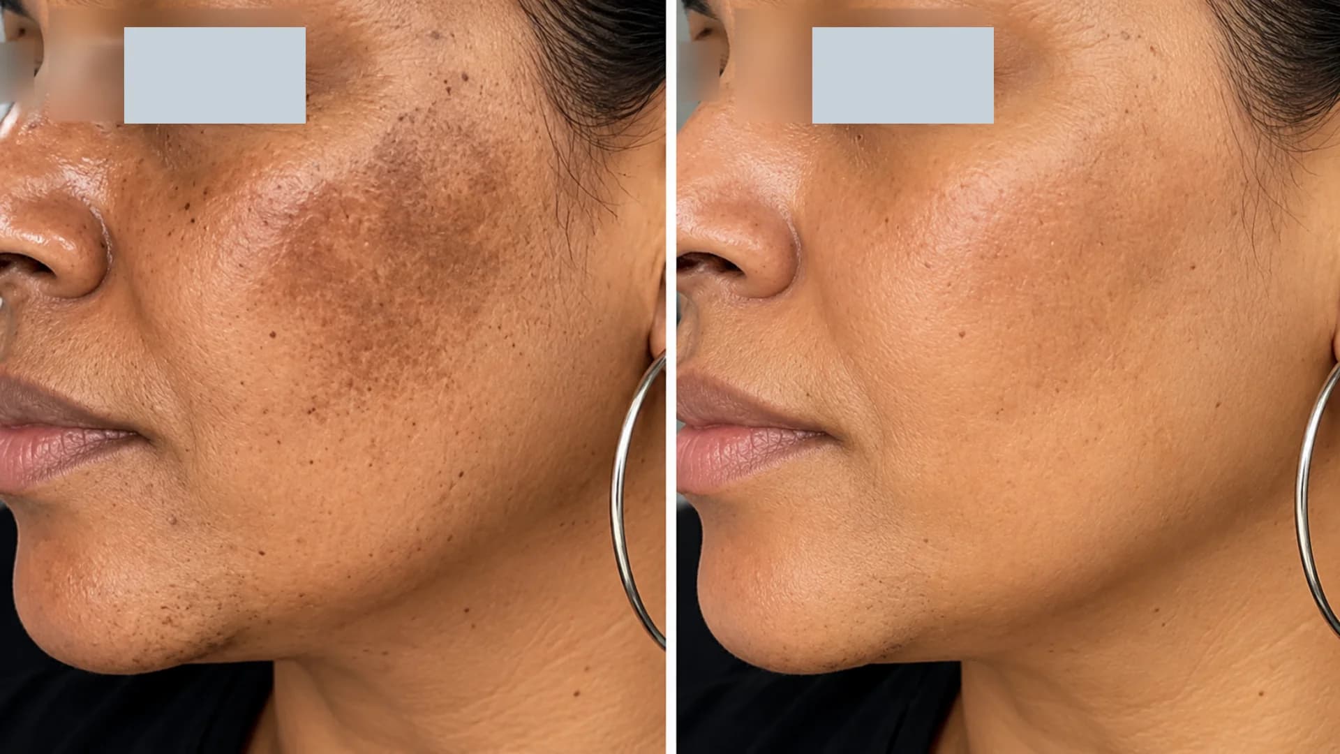 Melasma treatment before and after 3