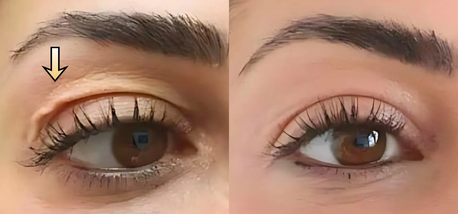 Non-Surgical Blepharoplasty before-and-after result: Plexr® Plus Eyelid Skin Tightening Case 7