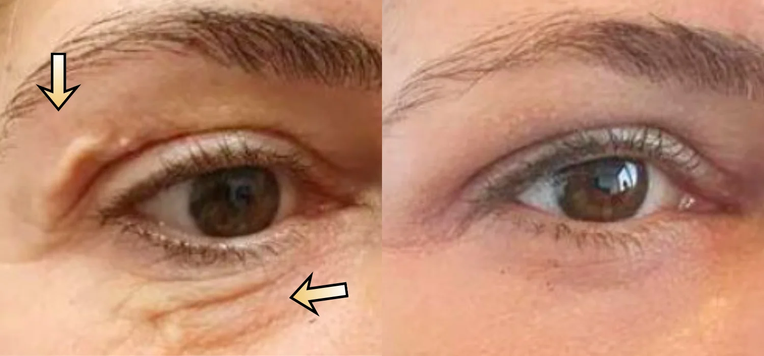 Non-Surgical Blepharoplasty before-and-after result: Plexr® Plus Eyelid Skin Tightening Case 6