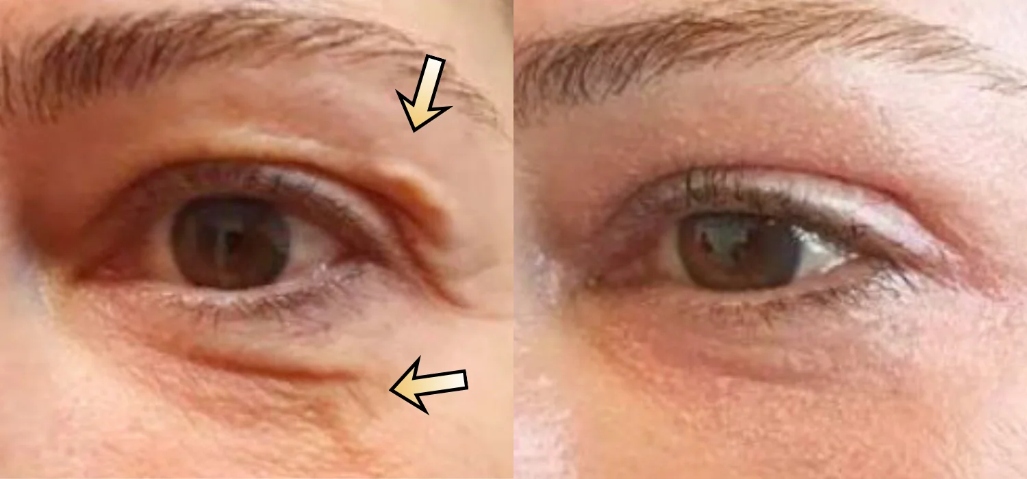 Non-Surgical Blepharoplasty before-and-after result: Plexr® Plus Eyelid Skin Tightening Case 5