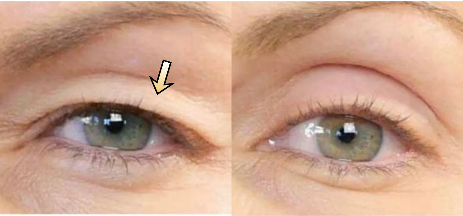 Non-Surgical Blepharoplasty before-and-after result: Plexr® Plus Eyelid Skin Tightening Case 4