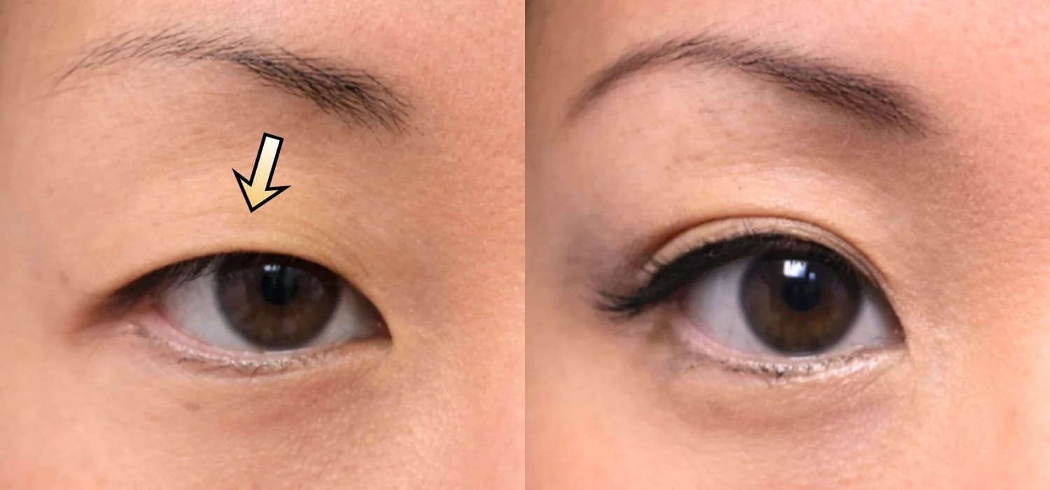 Non-Surgical Blepharoplasty before-and-after result: Plexr® Plus Eyelid Skin Tightening Case 3