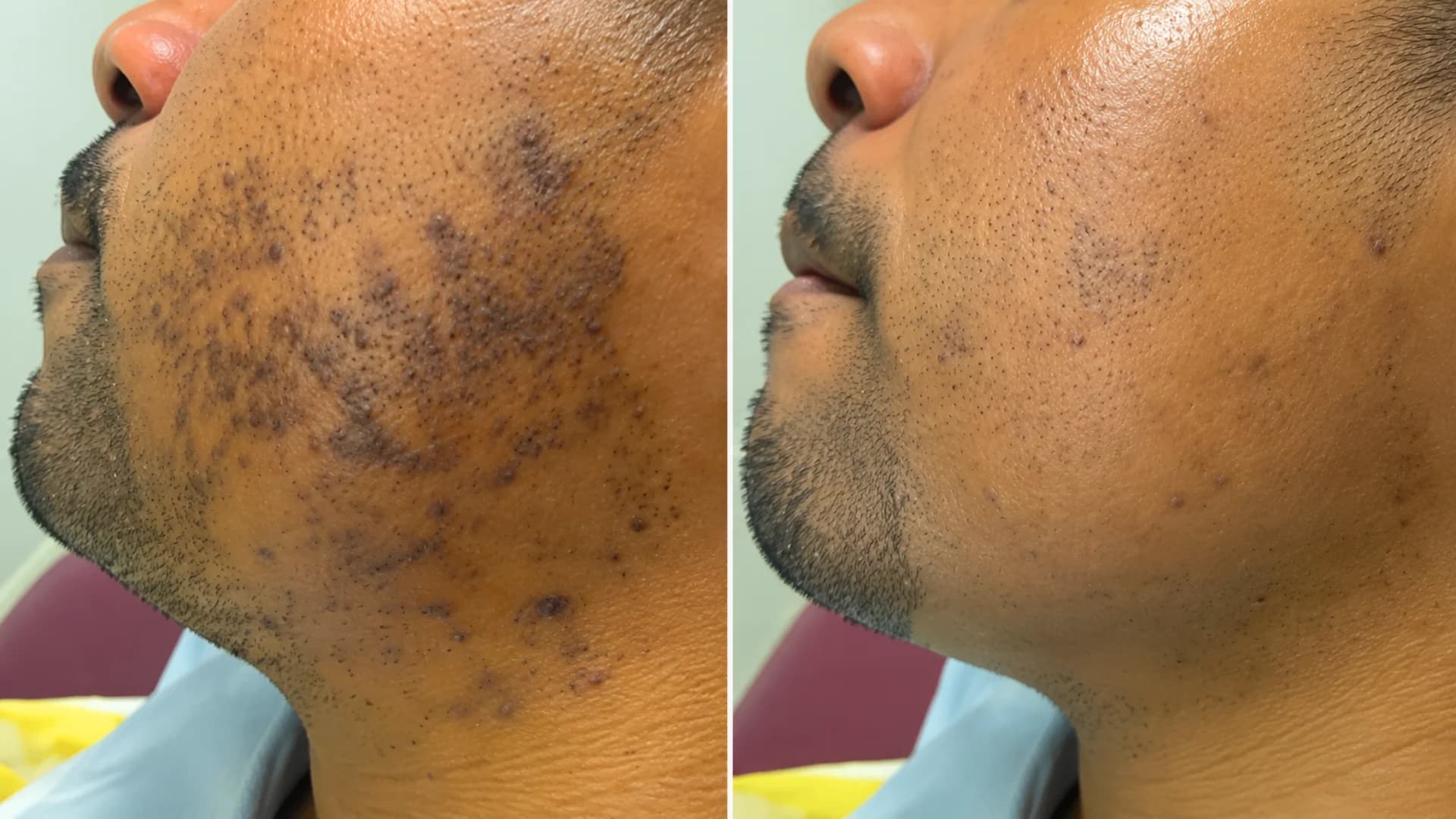 Laser PFB Clinical Result 3
