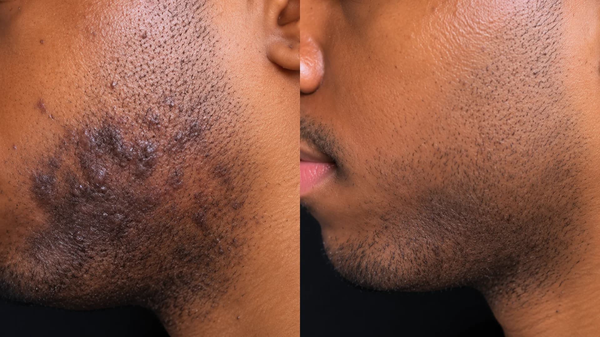 Laser PFB Clinical Result 1
