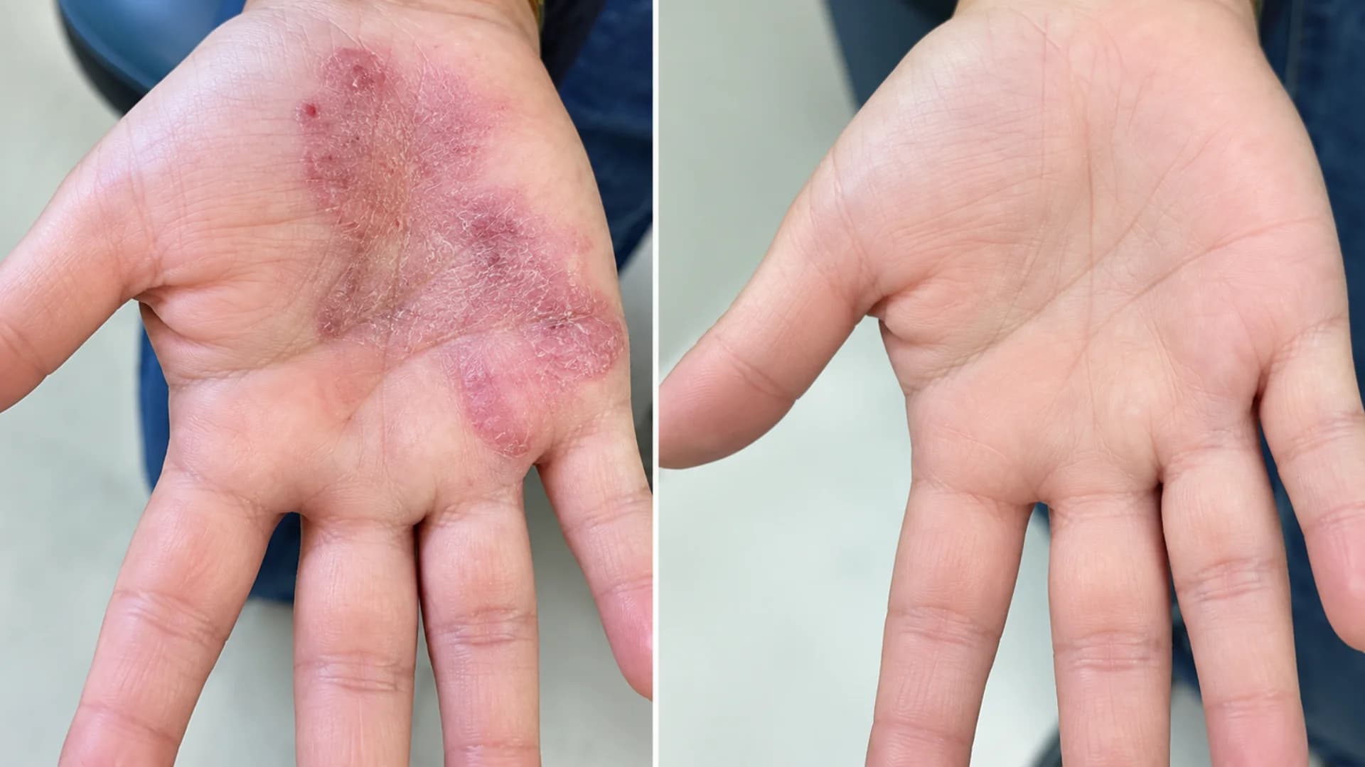 Laser Psoriasis Clinical Result 5