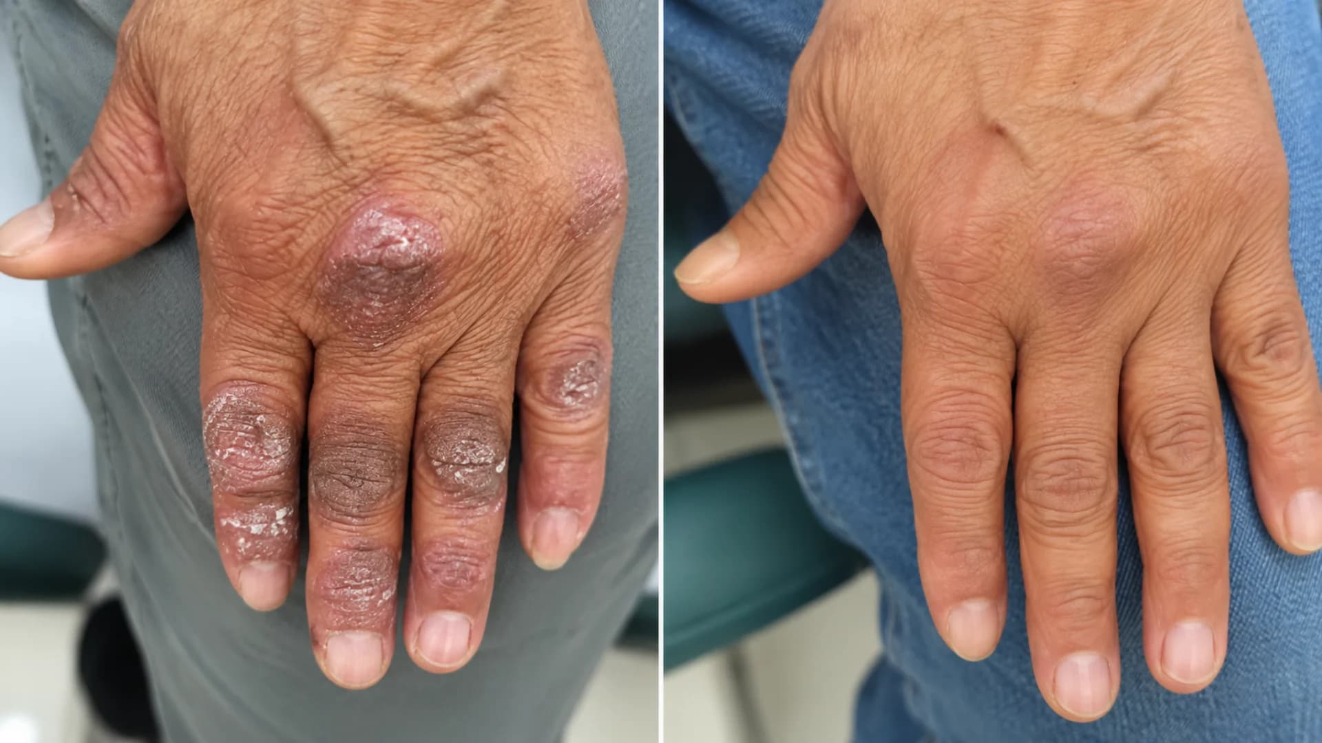Laser Psoriasis Clinical Result 4