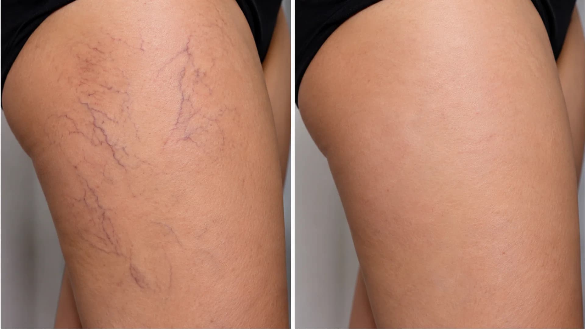 Laser Vein Clinical Result 4