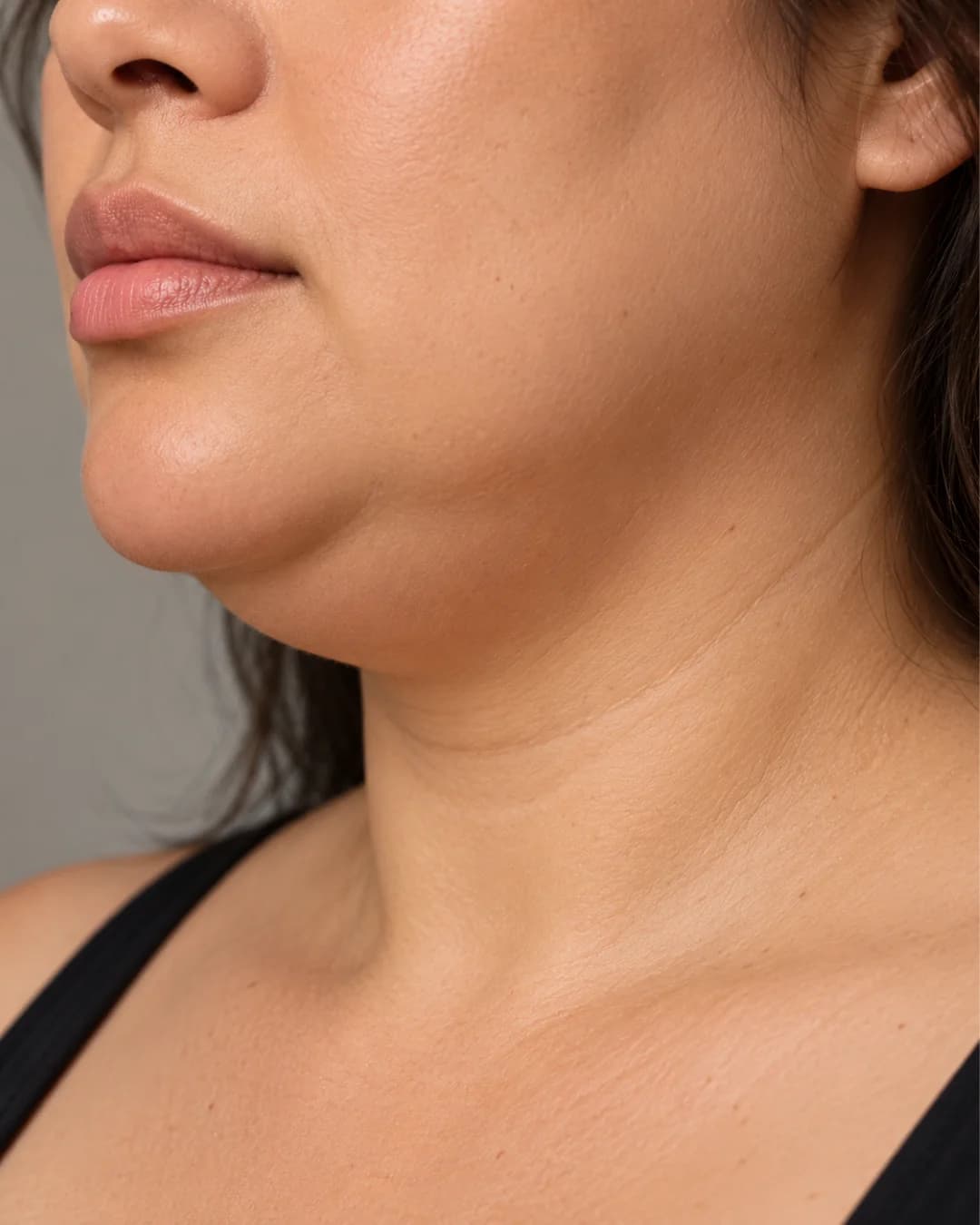Double Chin & Submental Fullness