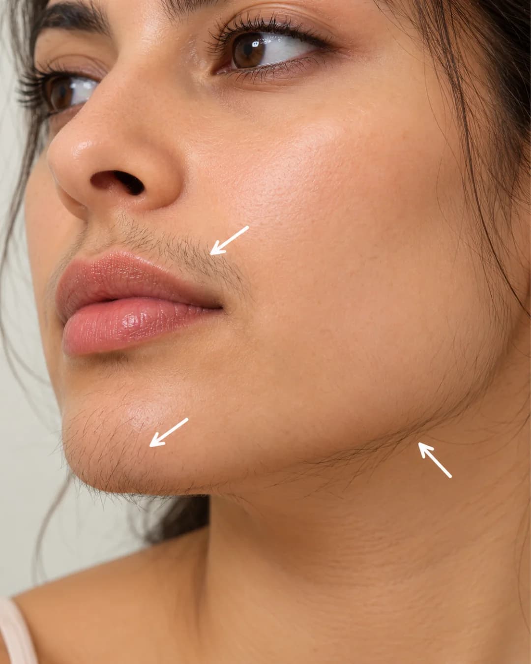 Hormonal & PCOS Facial Hair