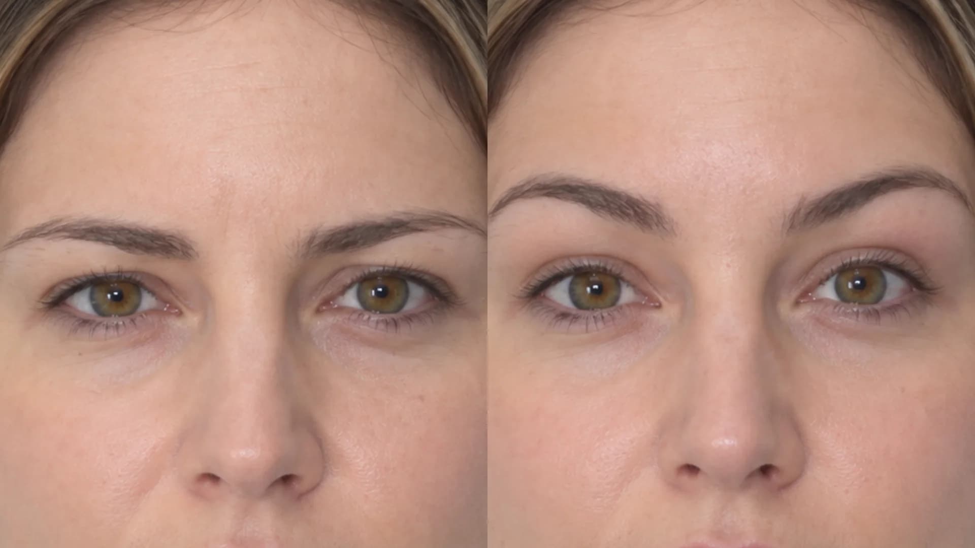 Non-surgical brow lift arch elevation
