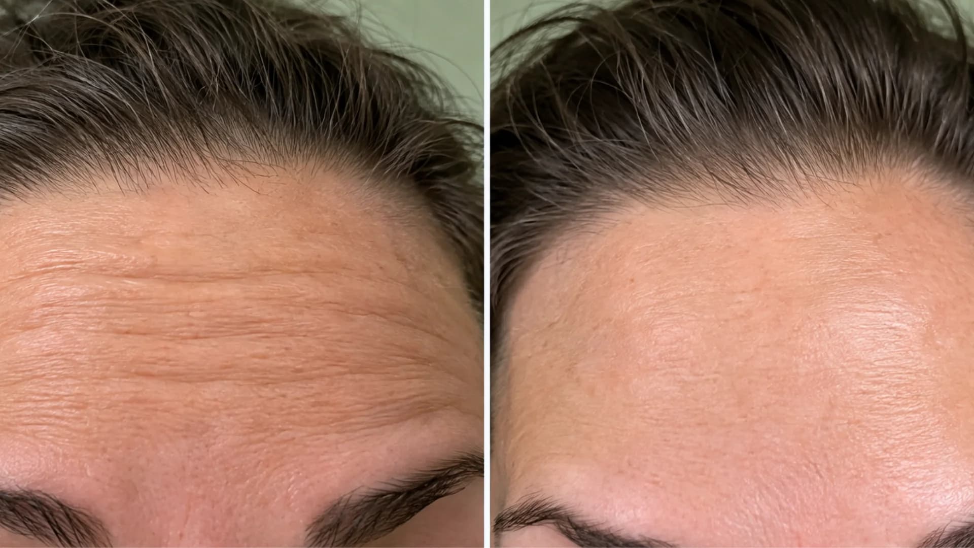 Forehead lines and horizontal dynamic wrinkles smoothing