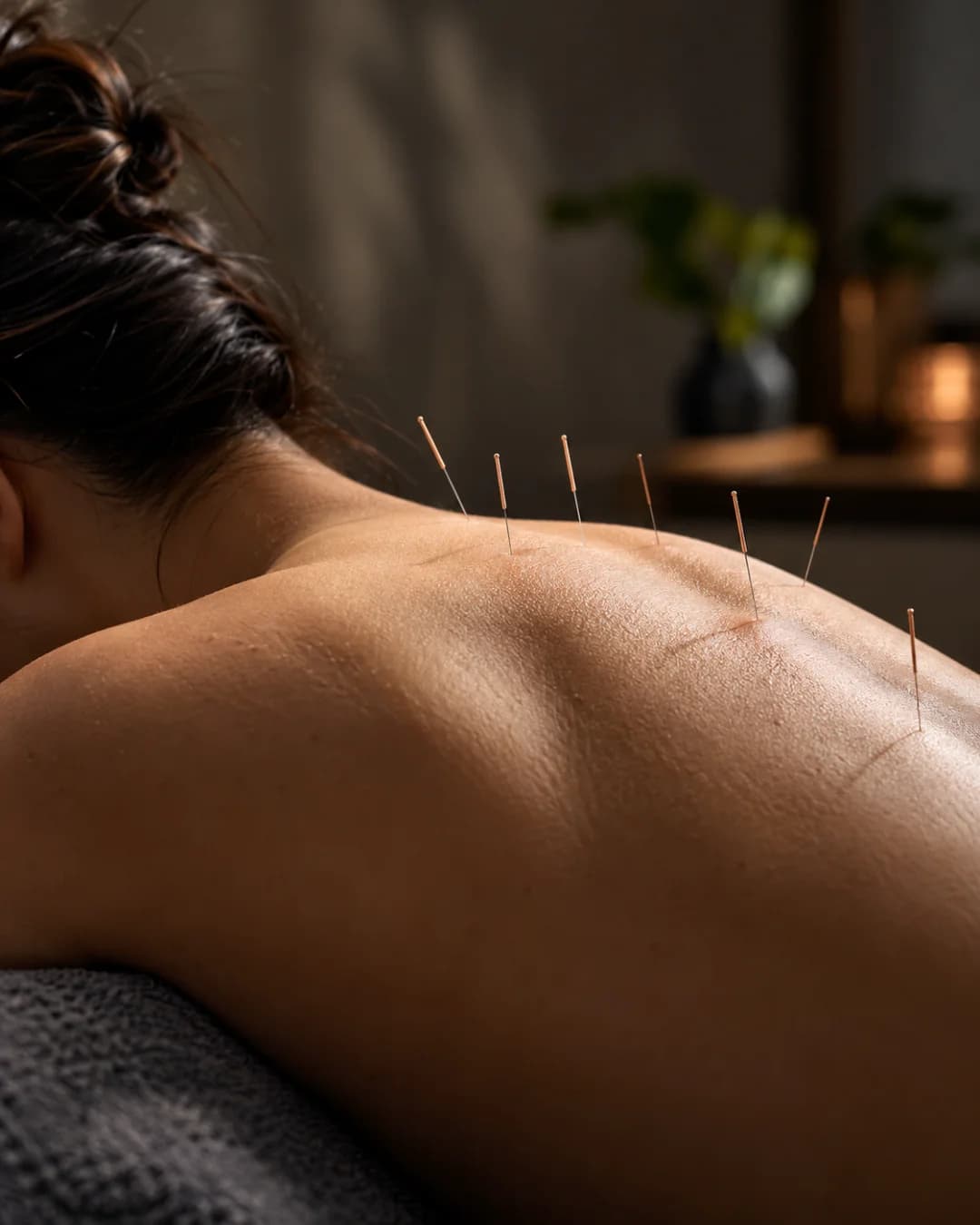 Acupuncture
