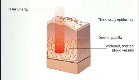 Illustration of laser energy directed at a psoriasis plaque and underlying blood vessels