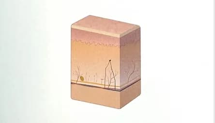 Illustration of a skin cross-section representing a possible treatment response