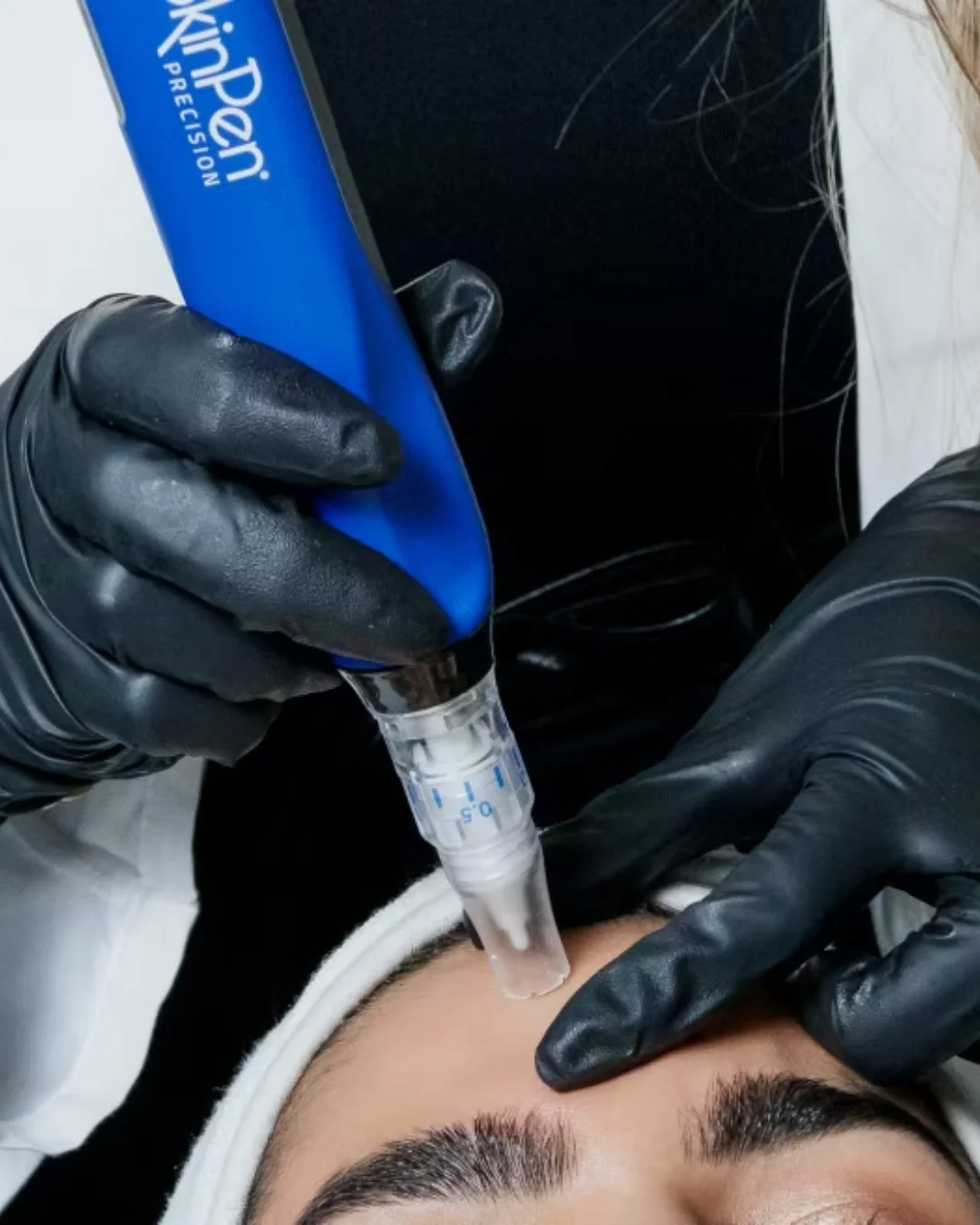 Classic Microneedling (SkinPen®)