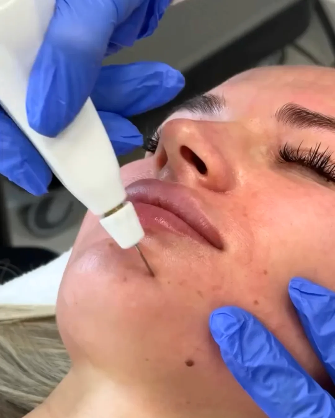 Plexr® Plus Cat Resurfacing