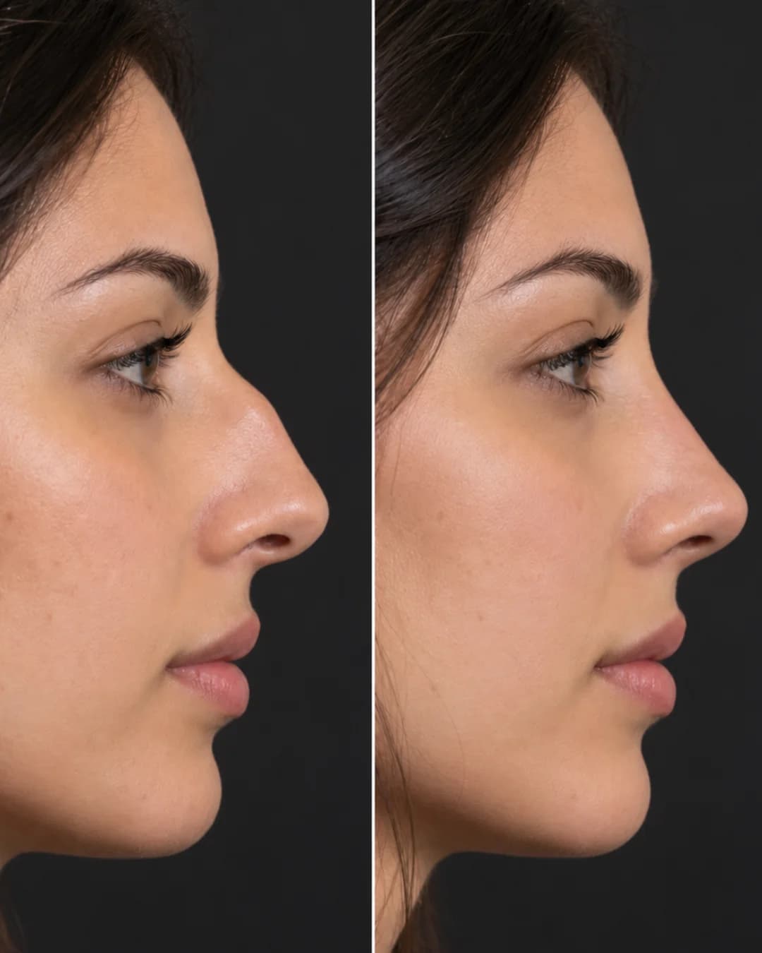 Non-surgical rhinoplasty and liquid nose reshaping consultation at Parsa Wellness Clinic