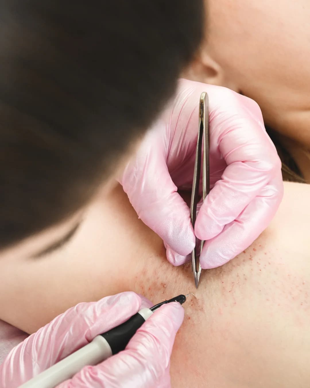 Electrolysis Permanent Hair Removal