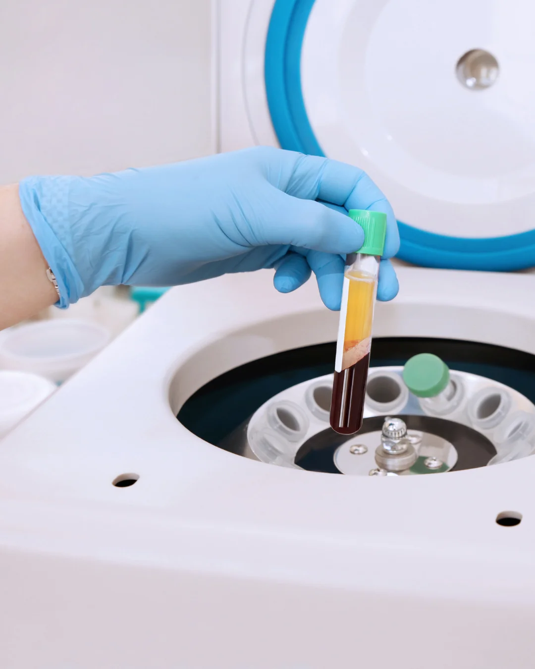 Centrifuge used to prepare platelet-rich plasma for PRP treatment