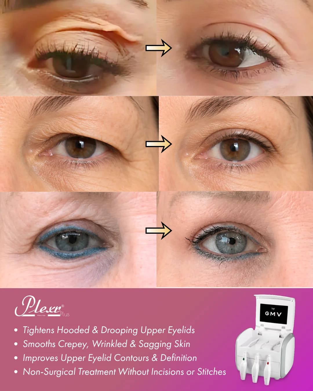Non-Surgical Blepharoplasty (Eyelid Lift)
