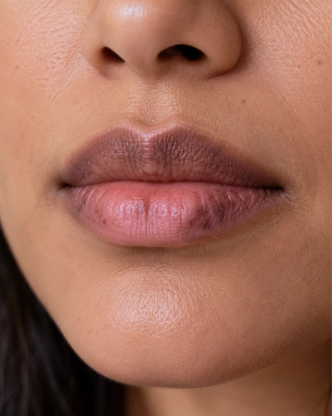 Dark Lips & Uneven Lip Pigmentation