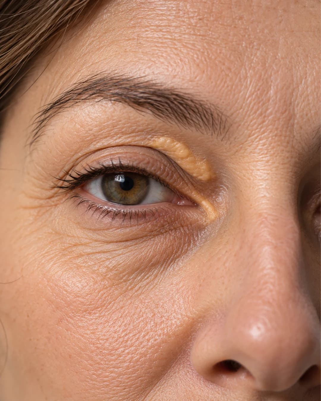 Xanthelasma (Yellow Eyelid Deposits)