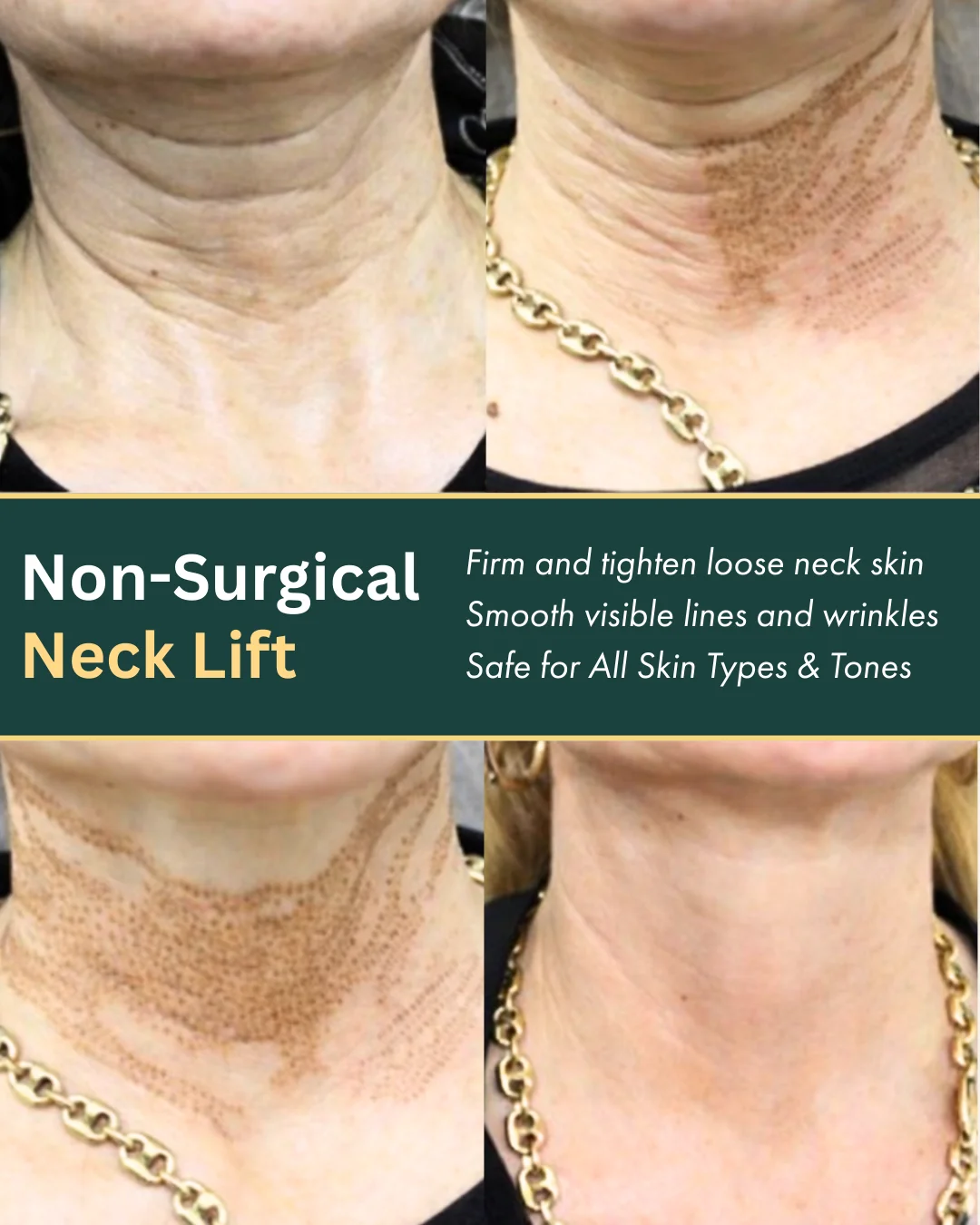 Before-and-after results from Plexr® Plus skin-tightening treatment